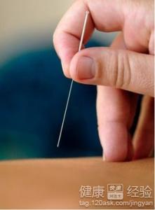 減肥針灸的穴位有哪些獨特的針灸減肥法