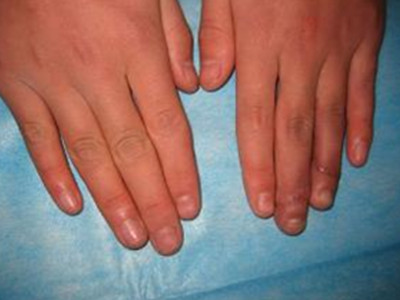 手指再造手術准備與護理方法介紹