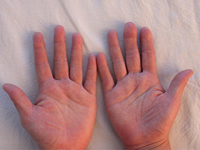 手指再造手術准備與護理方法介紹