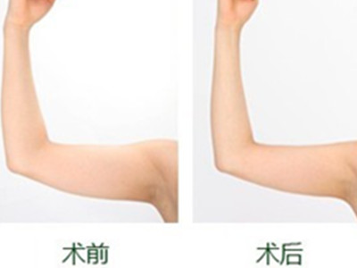 五種吸脂瘦手臂術 讓你擁有纖細玉臂