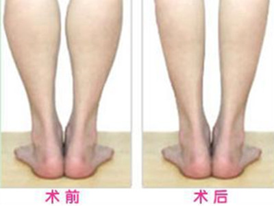 消除小粗腿 小腿縮小術的適應症